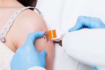 kryolipolyse Faltenbehandlung Botox Freising Hylauronsaeure Haut Laserzentrum Kurzen